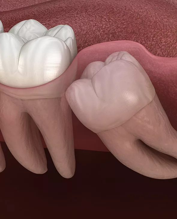 Closeup of wisdom teeth.